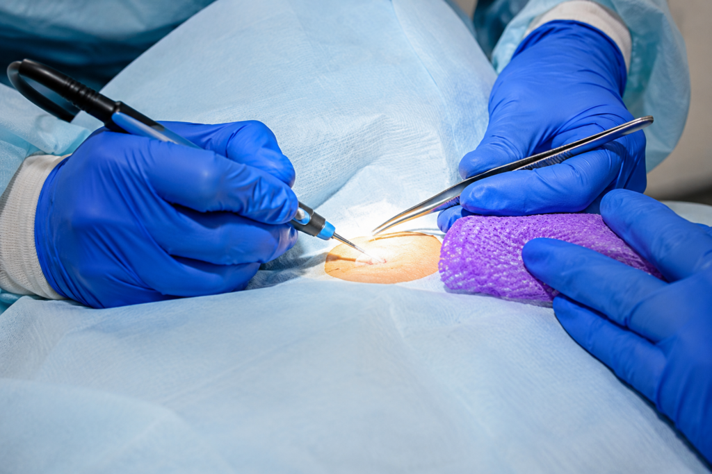 Cauterização de HPV