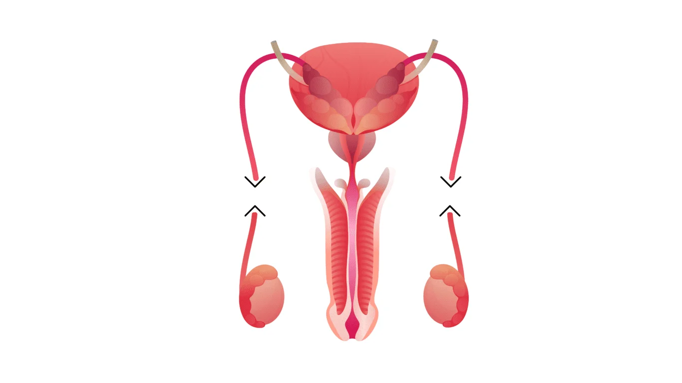 Vasectomia