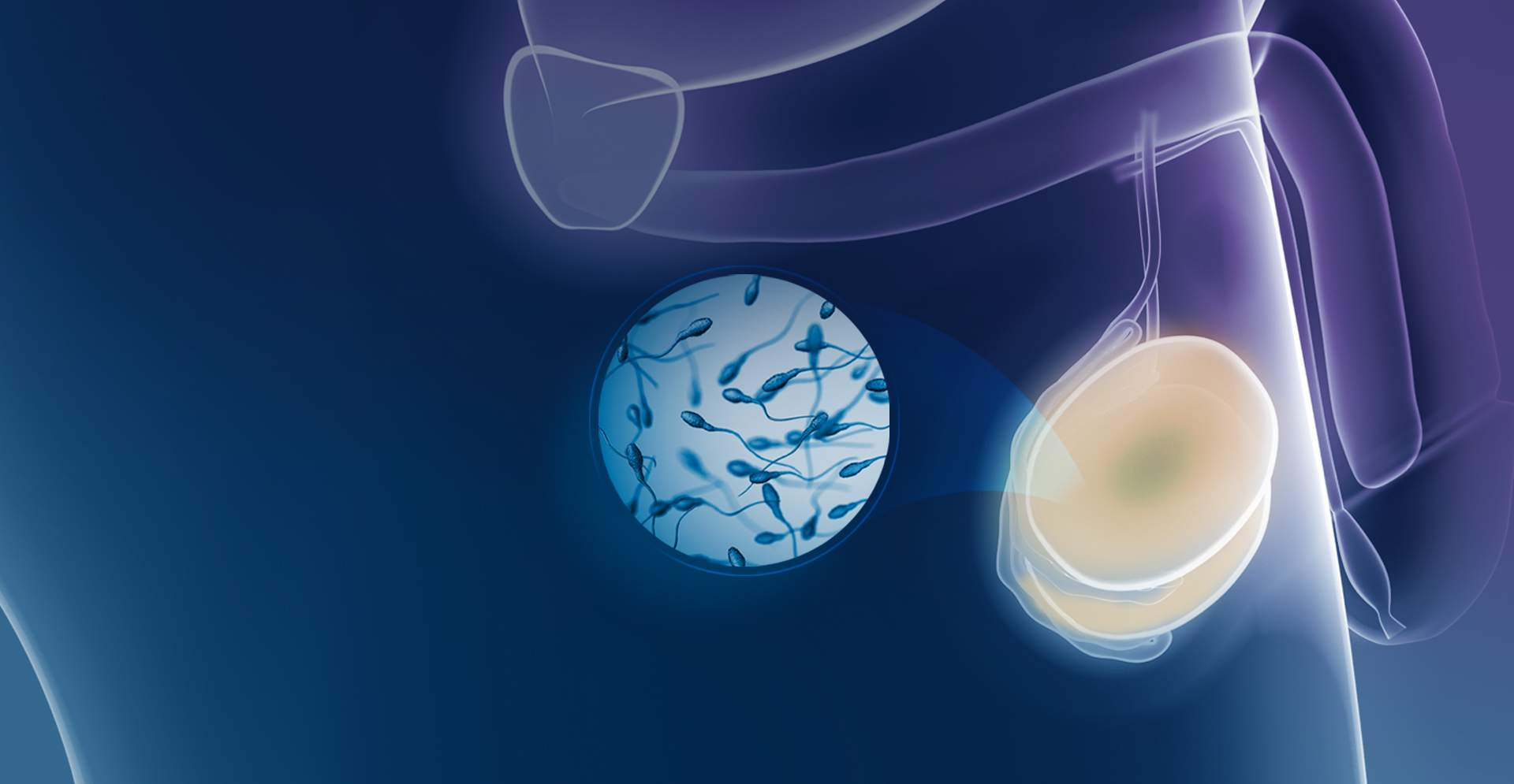 Extração de espermatozoide testicular (TESE) convencional (OTEM)