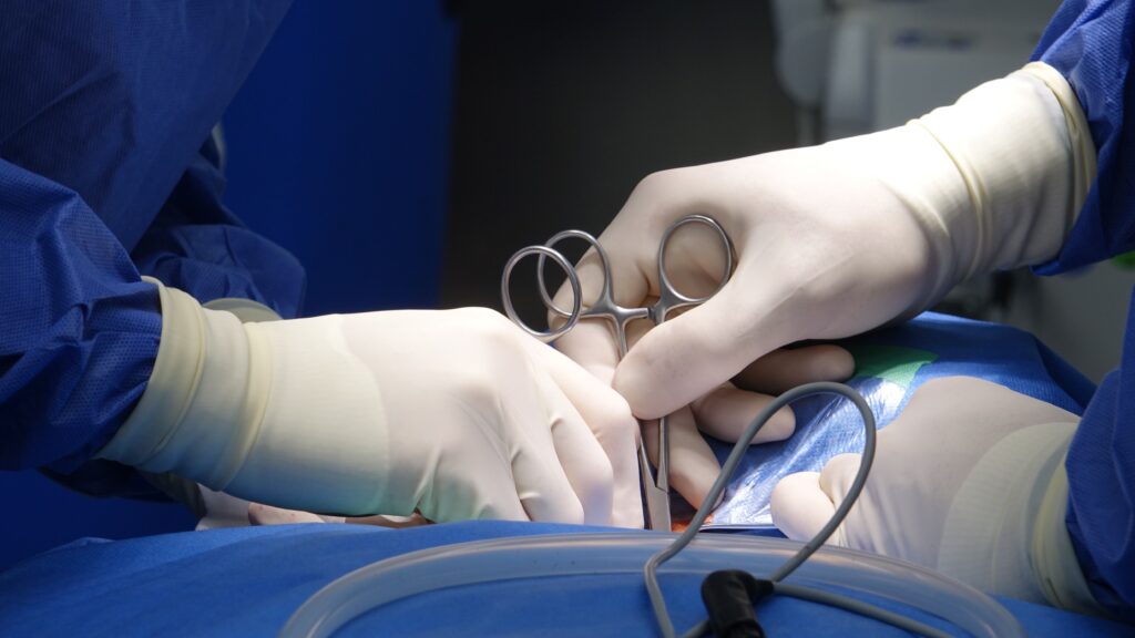 Reversão de varicocele microcirúrgica